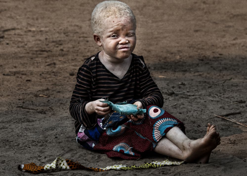 Pensive Albino Child by Joxe Inazio Kuesta Garmendia — canvas wall art