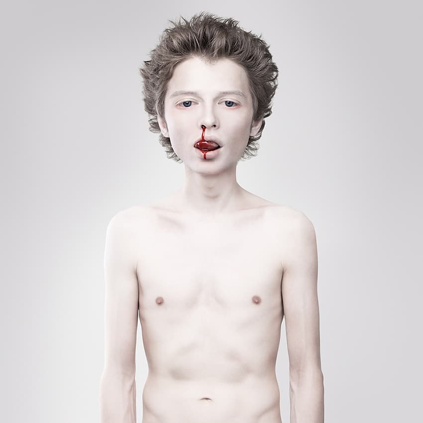 Young Boy's Nosebleed by Vladimir Katiev — canvas wall art