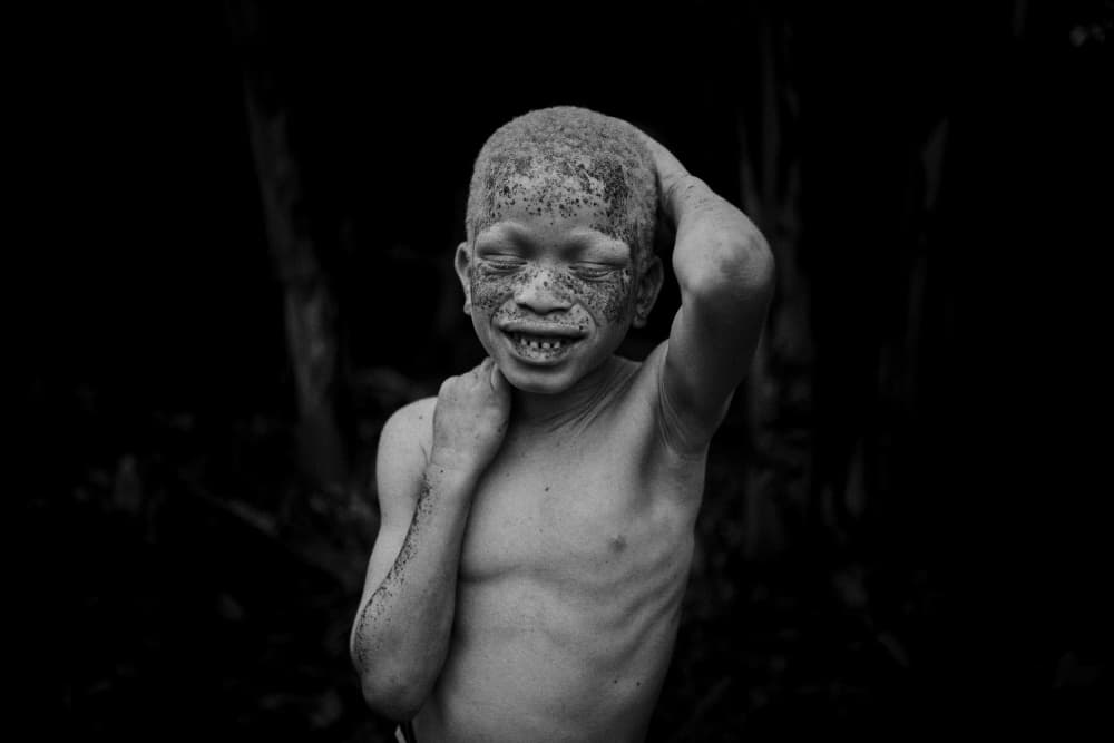 Smiling Albinistic Boy by Luís Godinho — canvas wall art