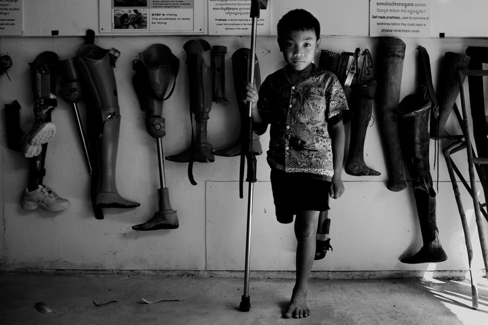 Child With Prosthetics by Shinji Isobe — canvas wall art