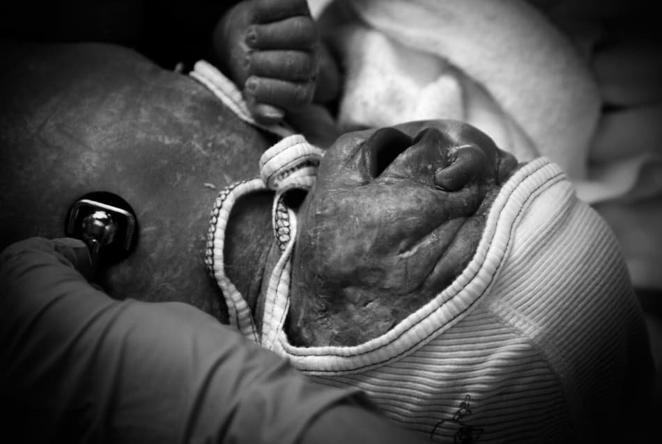 Newborn Medical Care by Niels Christian Wulff — canvas wall art